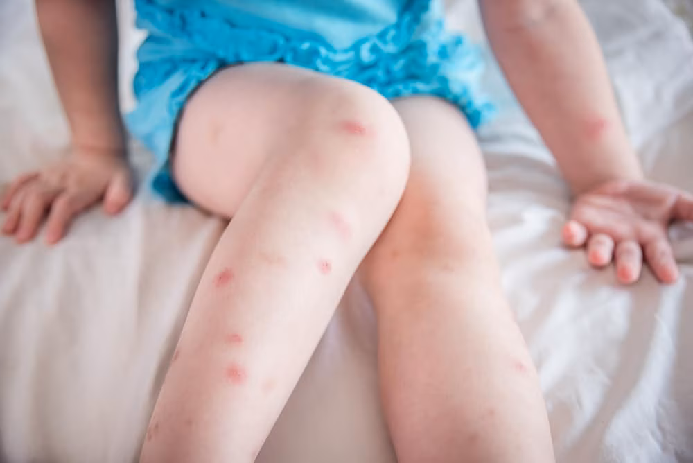 Bed bug and flea bite comparison in Ajax 2026