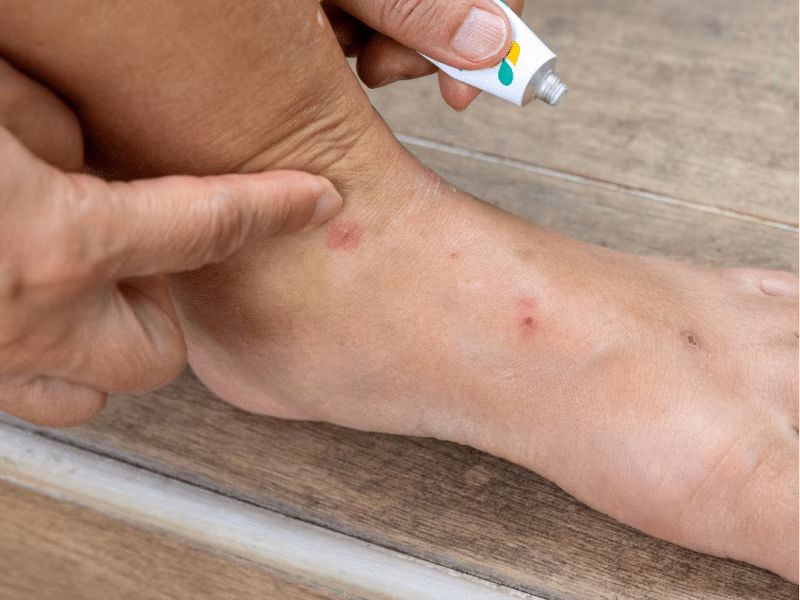 Person applying treatment cream to red bed bug bites on ankle