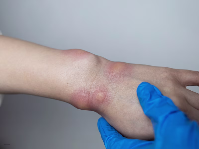 Health and Safety Risks of Bee Hives