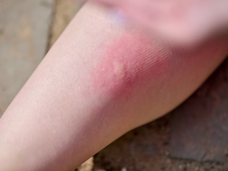 Close-up of mosquito bite reaction showing redness and swelling on skin